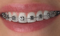Types of Braces  Braces in Vancouver & Lower Mainland BC
